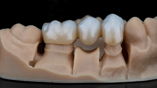 dental bridges in victoria, bc