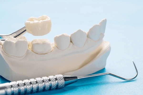 dental crowns in victoria, bc