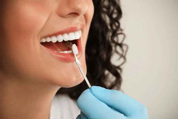 dental veneers near you