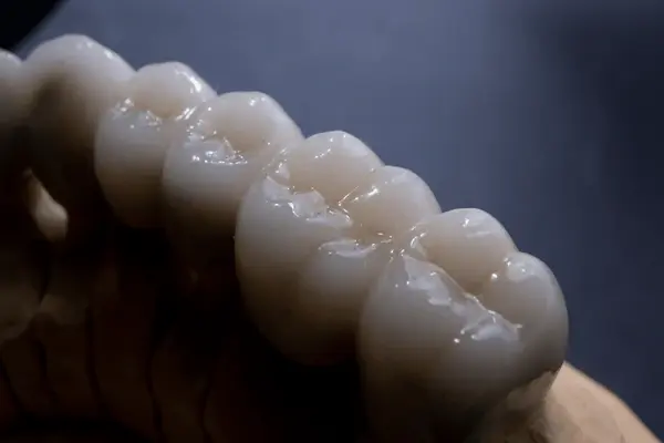 dental ceramics in victoria, bc