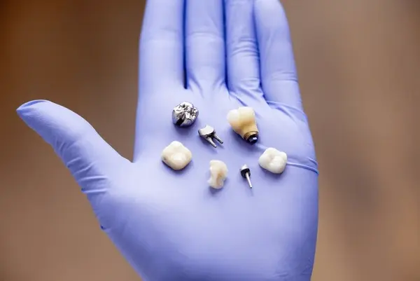 implant crowns in victoria, bc